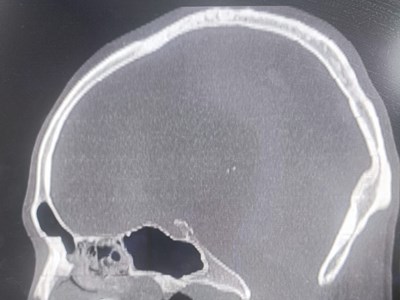 Mũi khoan cong xuyên mũi: Ca mổ “nín thở” cứu sống nam công nhân