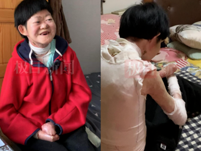 Từng bị chẩn đoán không sống quá 2 tuổi, “cô gái bươm bướm” hiện tại ra sao ở tuổi 25?