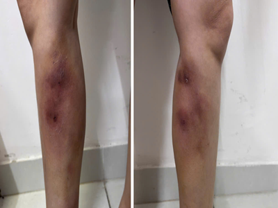 Cận cảnh đôi chân của cô gái 29 tuổi sau tiêm filler thẳng chân tại nhà