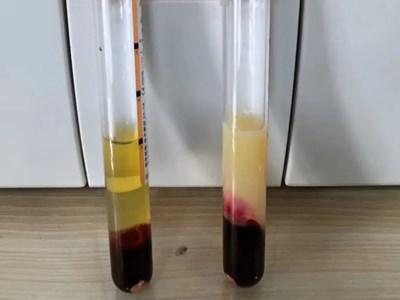 Vì sao tôi luôn kiểm soát mỡ máu nhưng khi khám lại vẫn không cải thiện, thậm chí bị nặng hơn?