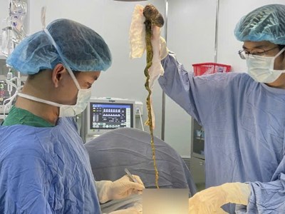 Phẫu thuật lấy búi tóc khổng lồ khỏi dạ dày bé trai 6 tuổi ở Đà Nẵng