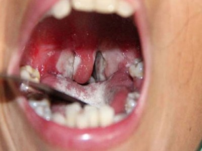 Phòng, chống bệnh bạch hầu như thế nào?