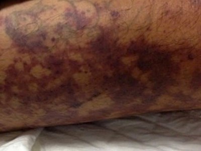 Thanh niên 32 tuổi nhiễm liên cầu lợn khi giết mổ lợn bệnh