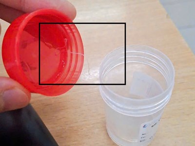 Gắp ký sinh trùng dài gần 10cm trong mắt người bệnh