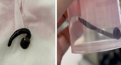 Cẩn trọng ký sinh trùng sống trong mũi trẻ vì tắm suối