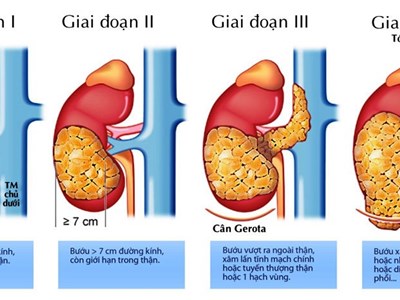 Tăng nguy cơ mắc ung thư thận vì hút thuốc lá