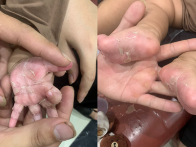 Phòng tránh lây truyền giang mai từ mẹ sang con 