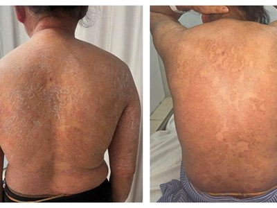 “Thảm họa” bôi thuốc trị bệnh nấm da không rõ nguồn gốc