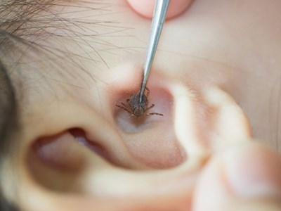 Trong nhà nuôi nhiều thú cưng, bọ chét ký sinh trên màng nhĩ bé gái 2 tuổi