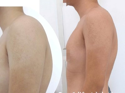 Điều trị gù lưng không cần phẫu thuật