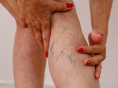 5 điều bác sĩ mạch máu nhắn nhủ bệnh nhân suy giãn tĩnh mạch ăn Tết vui khỏe, hạn chế gặp nhau trong bệnh viện