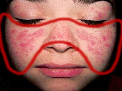Bệnh nhân lupus ban đỏ nhận TIN VUI ngay đầu năm mới