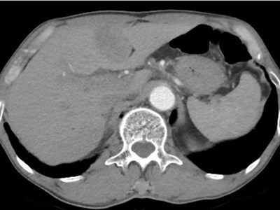 Sỏi mật có thể gây ung thư nếu không được điều trị sớm