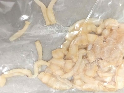 Phát hiện sán dây dài 3 mét sống trong ruột sau gần 1 năm đau bụng âm ỉ