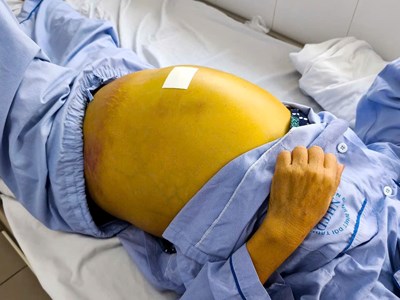 Phát hiện viêm gan B muộn, 2 bệnh nhân gặp bệnh lý nguy hiểm về gan