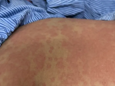 Nguy kịch sau khi dùng thuốc giảm cân thải độc không rõ nguồn gốc