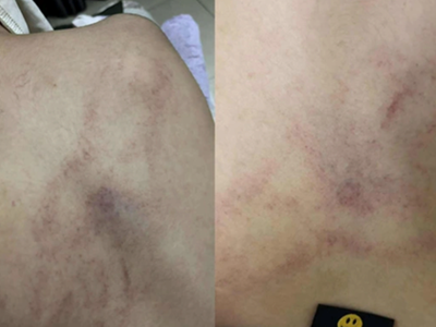 Đình chỉ cô giáo bị tố dốc ngược đầu trẻ, ném xuống giường ở Trường Mầm non Gia Thụy