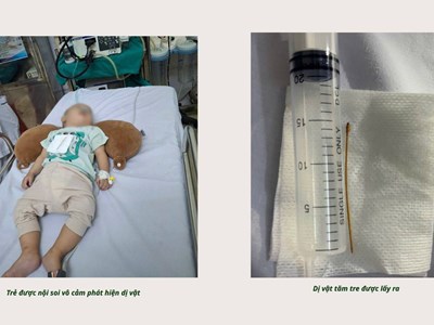 Lào Cai: Kịp thời nội soi gắp tăm tre trong ống tiêu hóa của bệnh nhi 7 tháng tuổi