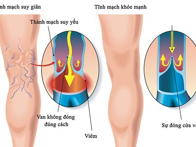 Bệnh suy tĩnh mạch mạn tính nguy hiểm thế nào?