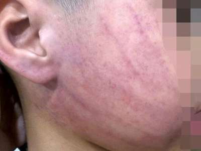 Công an vào cuộc điều tra vụ bé 4 tuổi nghi bị bạo hành tại trường mầm non ở Hà Nội