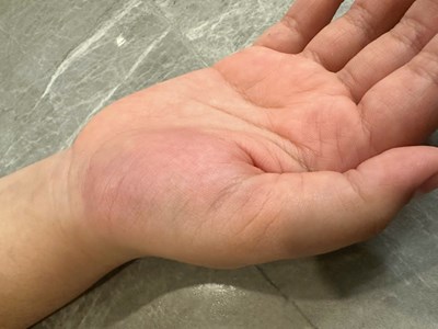 Xác minh vụ việc cô giáo đánh tay học sinh lớp 4 gây chấn thương