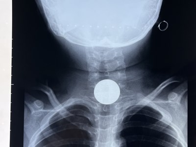 Gắp đồng xu bằng kim loại nằm ở thực quản của bé gái 7 tuổi