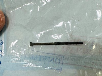 Gắp thành công một đinh vít dài 4cm trong dạ dày bệnh nhi 3 tuổi