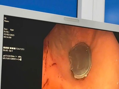 Gắp thành công nắp lon nước ngọt do bé trai 11 tuổi nuốt phải