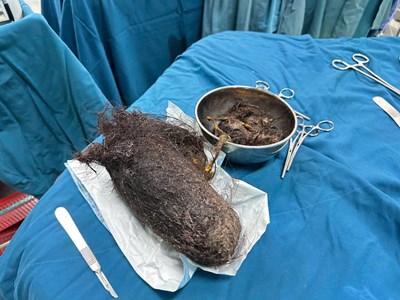 Phẫu thuật lấy thành công búi tóc gần 1kg trong dạ dày bé gái