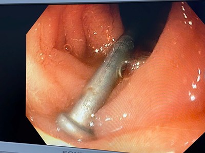 Gắp đinh sắt trong dạ dày bé trai