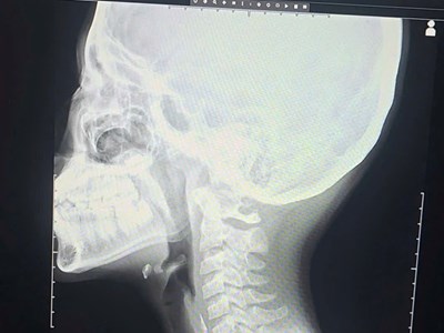 Nội soi gắp thành công mảnh xương gà dài 3cm cho bé trai 12 tuổi