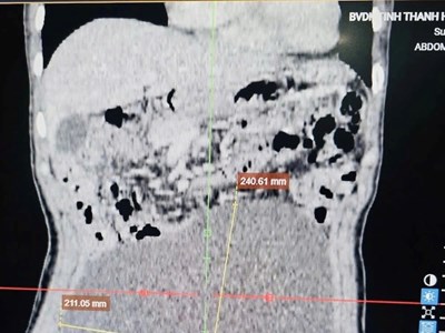 Cắt bỏ khối u buồng trứng gần 3 kg, cứu nữ bệnh nhân đau đớn suốt nhiều năm