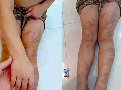 Làm rõ vụ việc 6 trẻ mầm non 5 tuổi bị bạn đánh bầm tím người