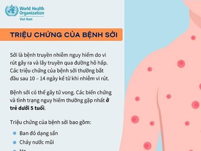 Nghệ An: Gần 1.100 ca sốt phát ban nghi sởi, nguy cơ bùng phát dịch