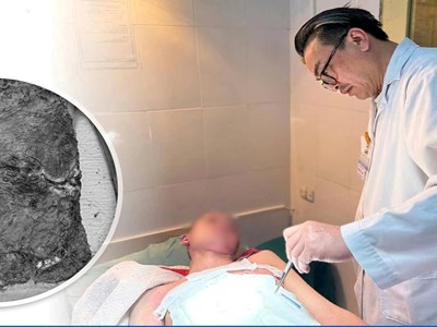 Nam sinh nhiễm trùng nặng do điều trị bỏng bằng thuốc nam tại nhà