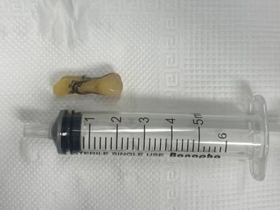 Ho khó thở, cụ ông 81 tuổi được phát hiện răng rơi vào phế quản