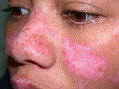 Cô gái Huế đột ngột qua đời trước ngày cưới nửa tháng do mắc bệnh lupus ban đỏ: Cảnh báo 1 nhóm phụ nữ nguy cơ cao mắc bệnh