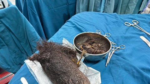 Phẫu thuật lấy thành công búi tóc gần 1kg trong dạ dày bé gái