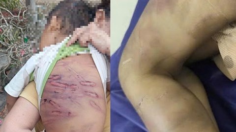  Bộ Y tế đề nghị kịp thời cứu chữa cho bé 2 tuổi bị bạo hành nghiêm trọng