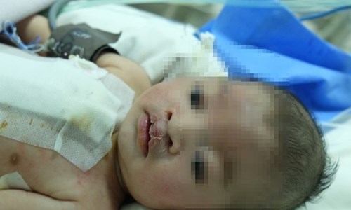 Bé gần 2 tháng tuổi đã trải qua 2 cuộc phẫu thuật tim và hở môi - Anh 1