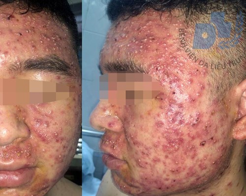 Dùng thuốc nam không nguồn gốc, nam thanh niên mụn bọc đầy mặt - Anh 1