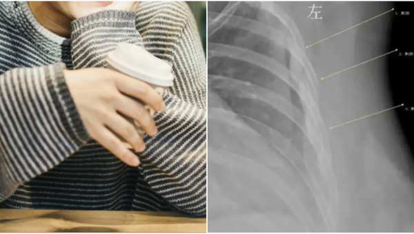 Uống 10 cốc cà phê mỗi ngày trong 7 năm, cô gái 30 tuổi có xương như cụ già - Anh 1