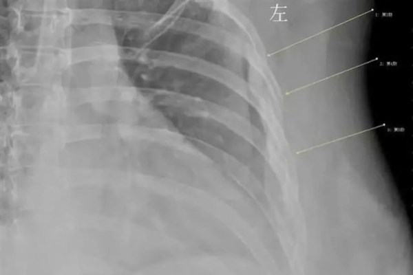 Uống 10 cốc cà phê mỗi ngày trong 7 năm, cô gái 30 tuổi có xương như cụ già - Anh 2