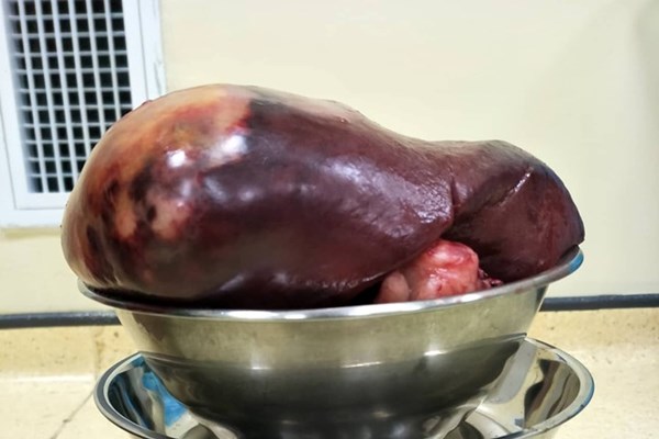 Một thanh niên có u lách 