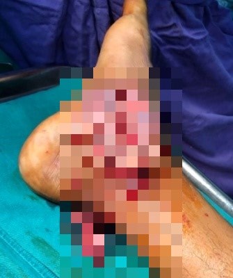 Suýt mất chân do tự điều trị thuốc nam tại nhà - Anh 2