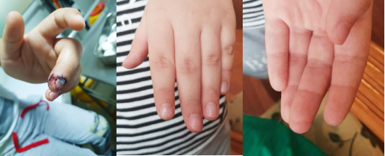 Phẫu thuật kịp thời cứu búp ngón tay cho bé trai người Nga - Anh 1