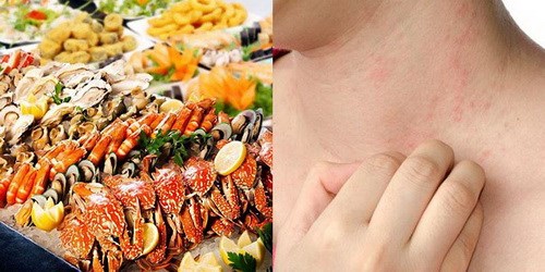 Cẩn trọng với dị ứng thực phẩm mùa du lịch - Anh 1