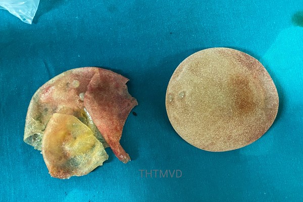 “Cứu” vòng 1 của một phụ nữ bị vỡ túi nâng ngực - Anh 1