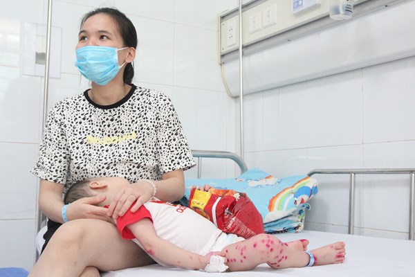 Hơn 60% ca mắc nhập viện, Bộ Y tế yêu cầu tăng cường phòng chống dịch tay- chân- miệng - Anh 1