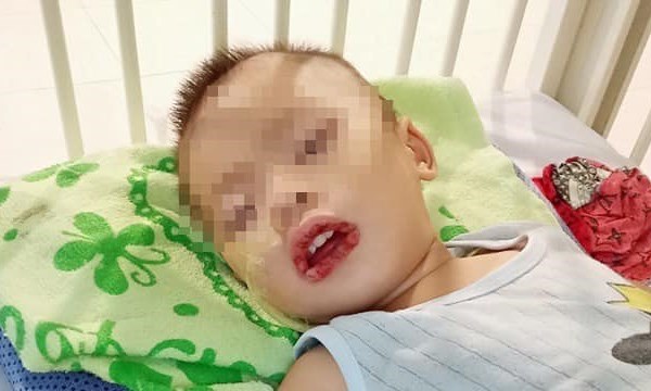 Thuốc tẩy bồn cầu đựng trong chén khiến bé 21 tháng tuổi uống nhầm - Anh 1
